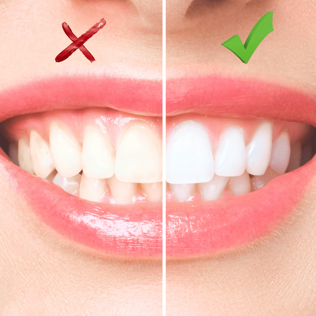 afbeelding voor en na foto tandverkleuring en wittere tanden