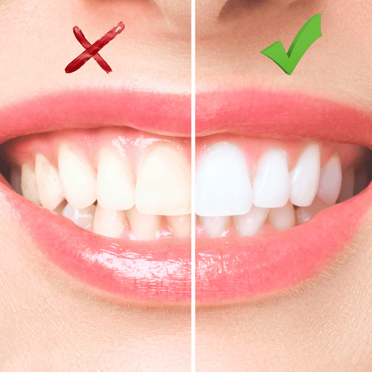 afbeelding voor en na foto tandverkleuring en wittere tanden